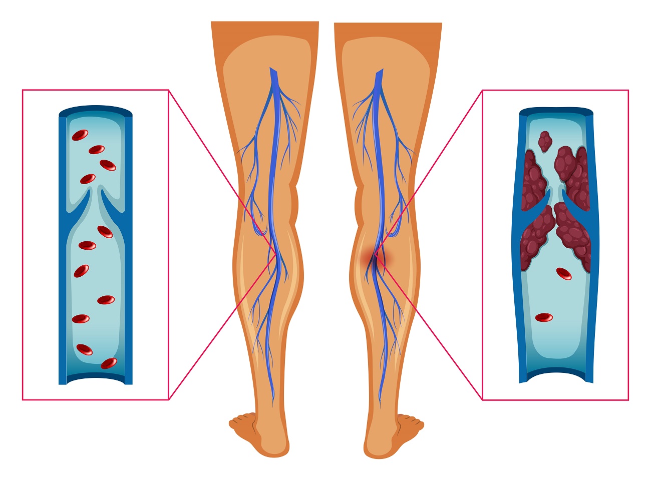 "Schéma phlébite ou thrombose veineuse - caillot sanguin"