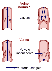 "Schéma de la maladie veineuse chronique - varice"